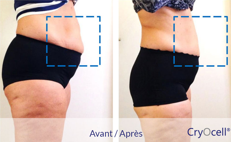 résultats avant et après deux séances de cryolipolyse ventre