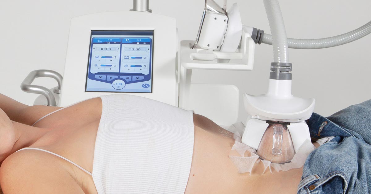 cryolipolyse de la graisse du ventre avec une poignée d'aspiration et de refroidissement