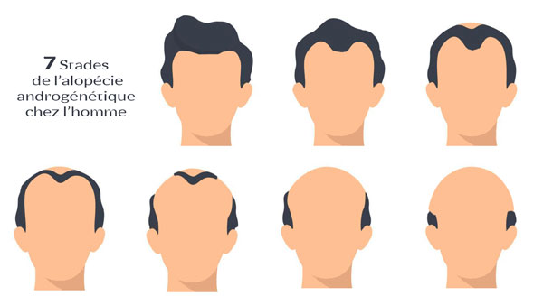 7 stades de l'alopécie androgénétique chez l'homme