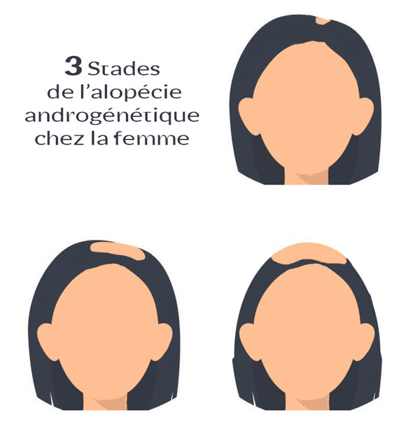 3 stades de l'alopécie androgénétique chez la femme