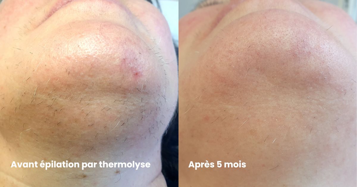 Résultats avant après épilation visage par thermolyse
