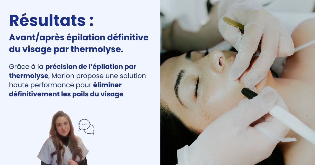vignette l'avis de Marion Têtard sur l'épilation par thermolyse