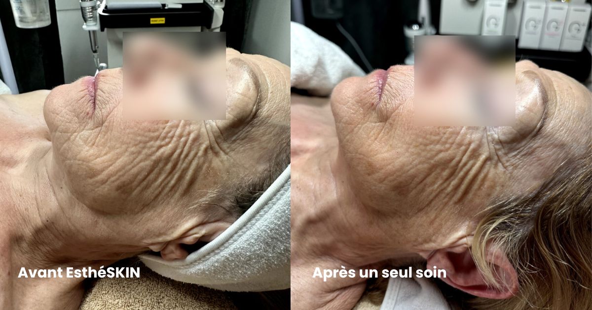 Résultats avant après soin EsthéSkin sur des signes de vieillissement
