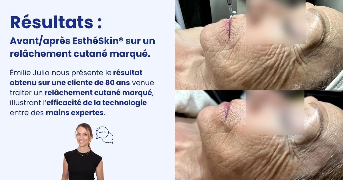vignette les résultats avant/après EsthéSkin sur un relâchement cutané