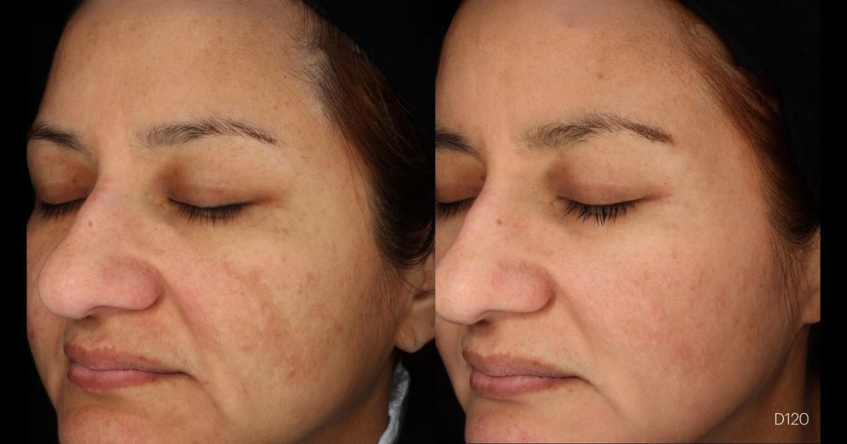 avant après soin anti tache hyperpigmentation cosmelan