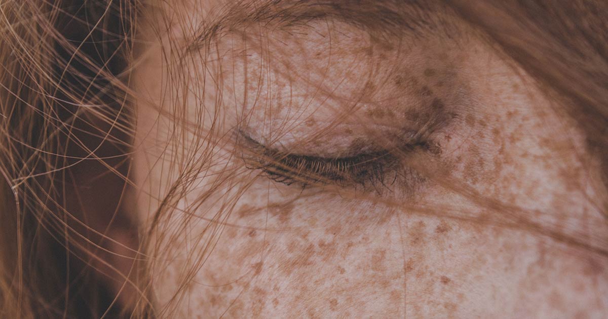 photographie d'un visage à la peau claire avec des taches pigmentaires