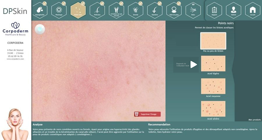 Diagnostic de peau DP Skin : points noirs