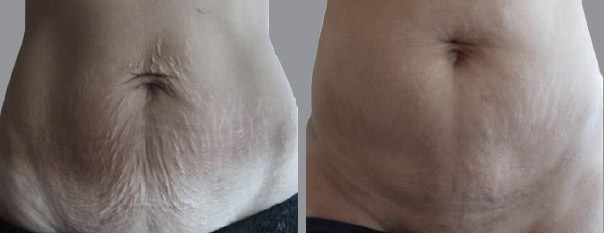 avant après : traitement anti-vergetures par LED