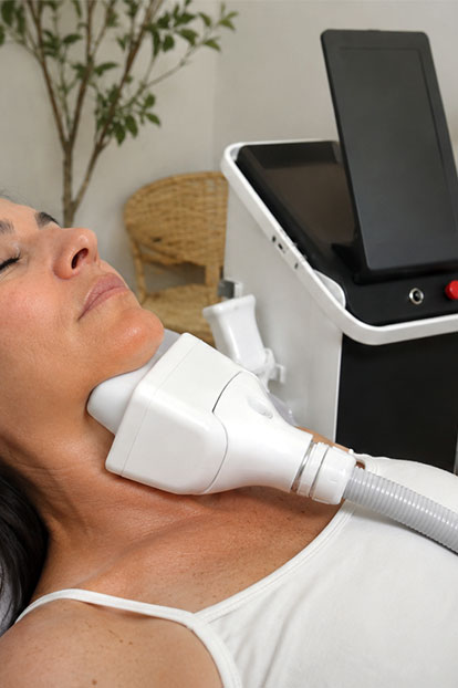 cryolipolyse du menton avec Cryocell 360 IA