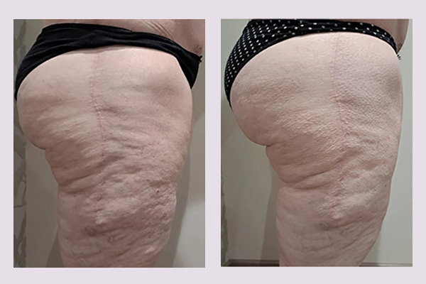 Avant -après traitement minceur cuisses avec Adipologie®