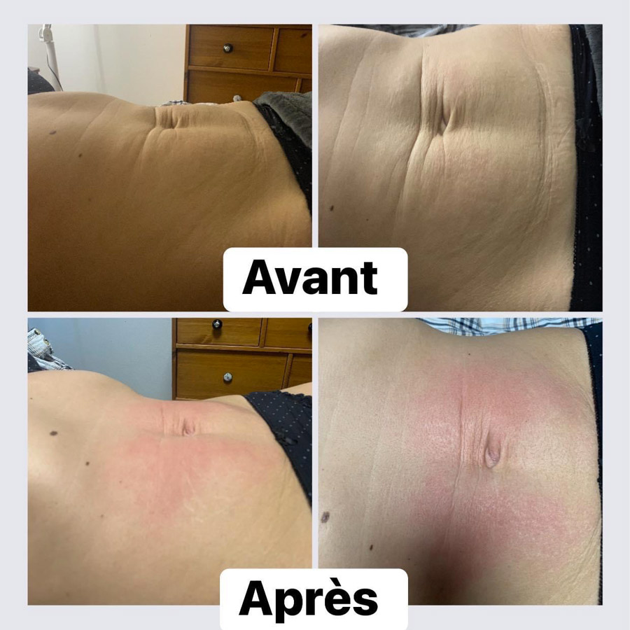 avant après | perdre du ventre avec Diasculpt
