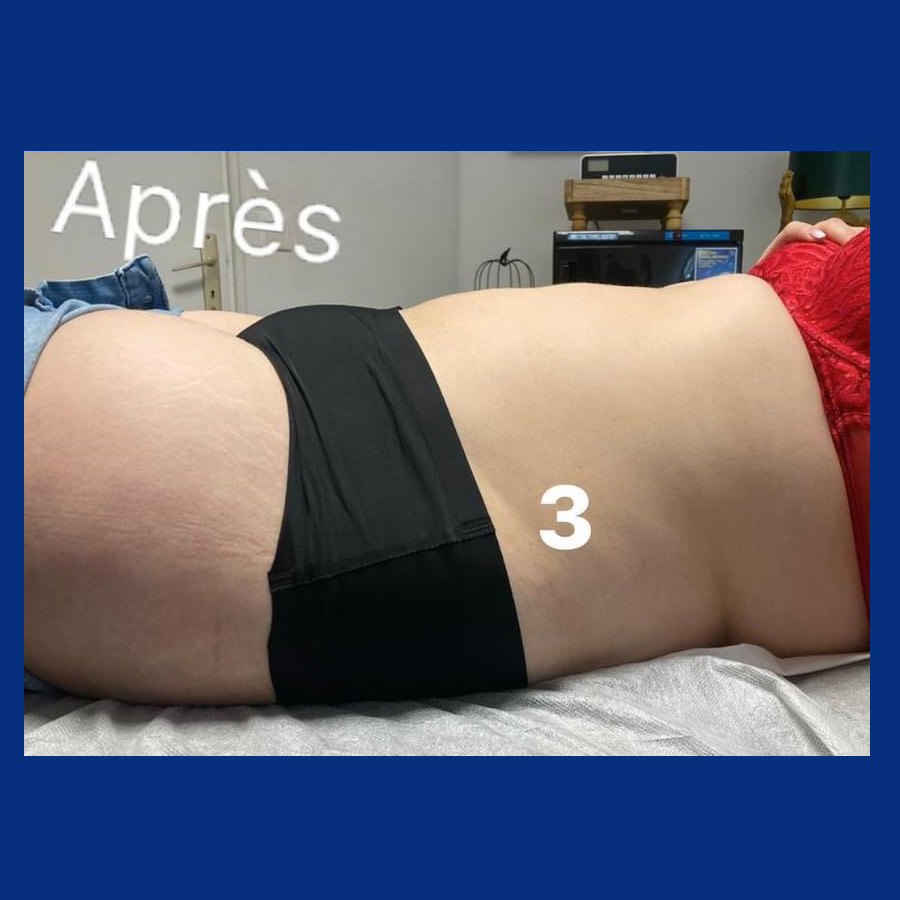 après une cure minceur avec Diasculpt