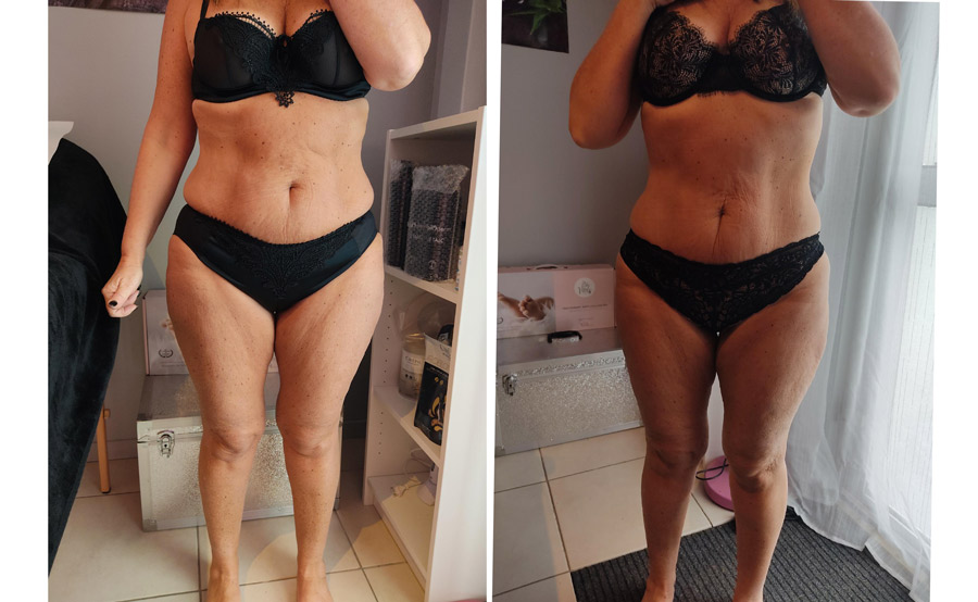avant et après une cure minceur EsthéShape