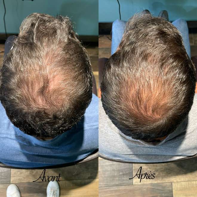 Avant après photobiomodulation cheveux et cuir chevelu