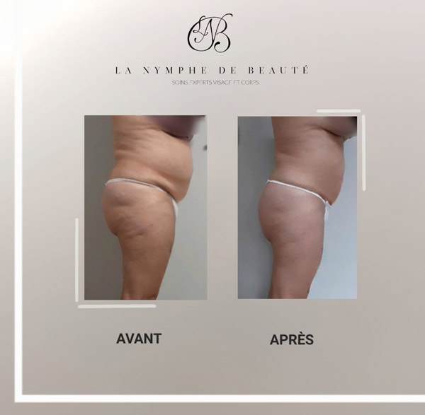avant après  minceur Adipologie  