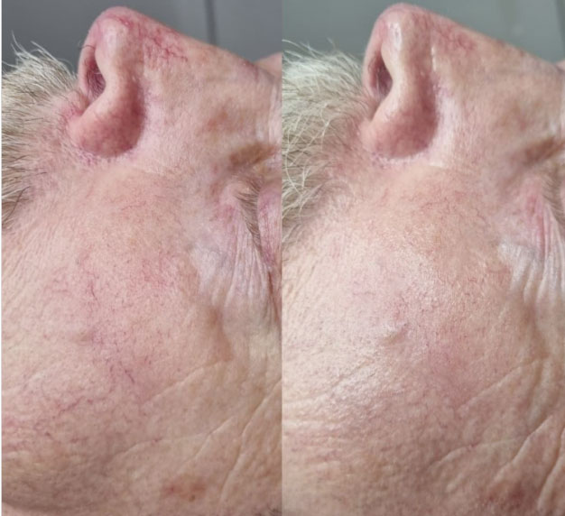avant après traitement des capillaires sanguins sur le visage par lumière pulsée