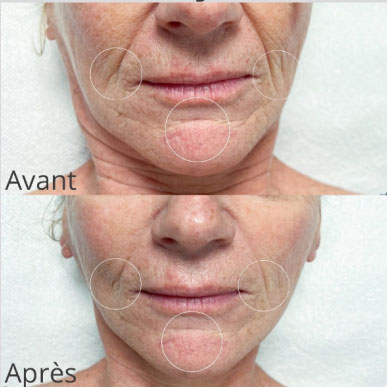 avant après diminution des rides d'expression avec la lumière pulsée