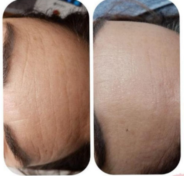 avant après lumière pulsée rides du front