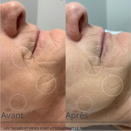 avant après diminution des rides d'expression avec la lumière pulsée