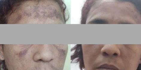 avant après lumière pulsée tache soleil visage