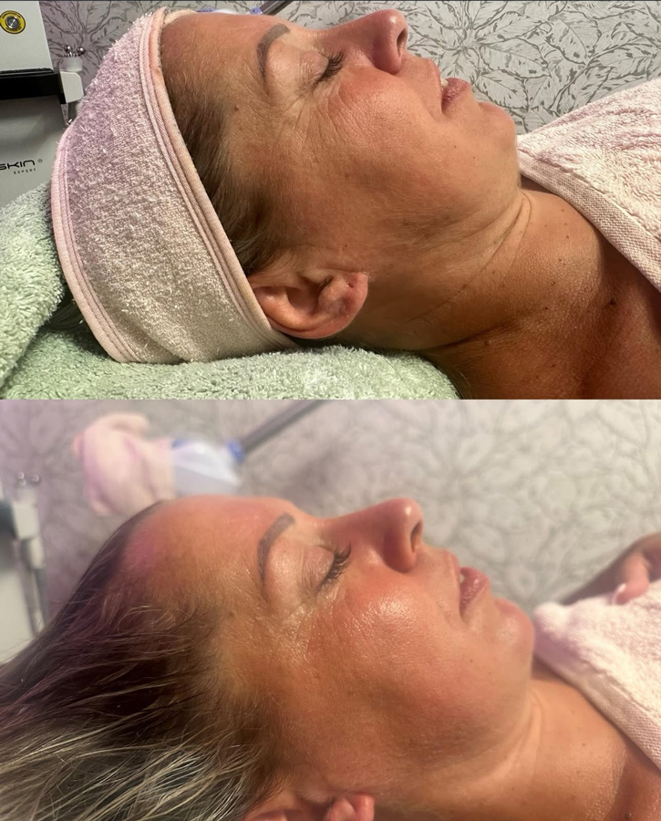 Avant-Après soin flash EsthéSkin® (x séances)