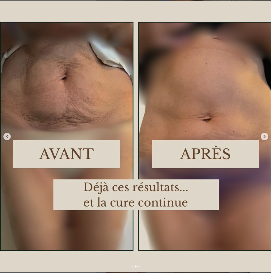 cure minceur Genesis® : résultats avant/après (intermédiaire)