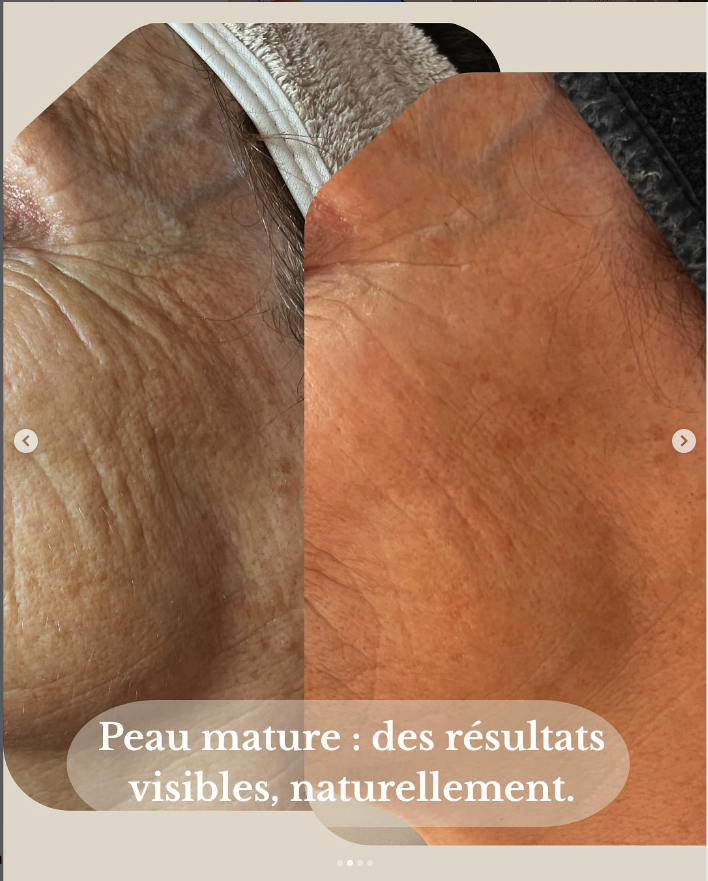 Cure anti-âge Genesis® : résultats avant/après