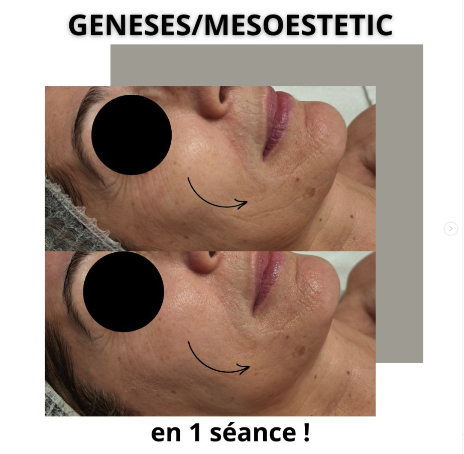 avant après radiofréquence mesoestetic®