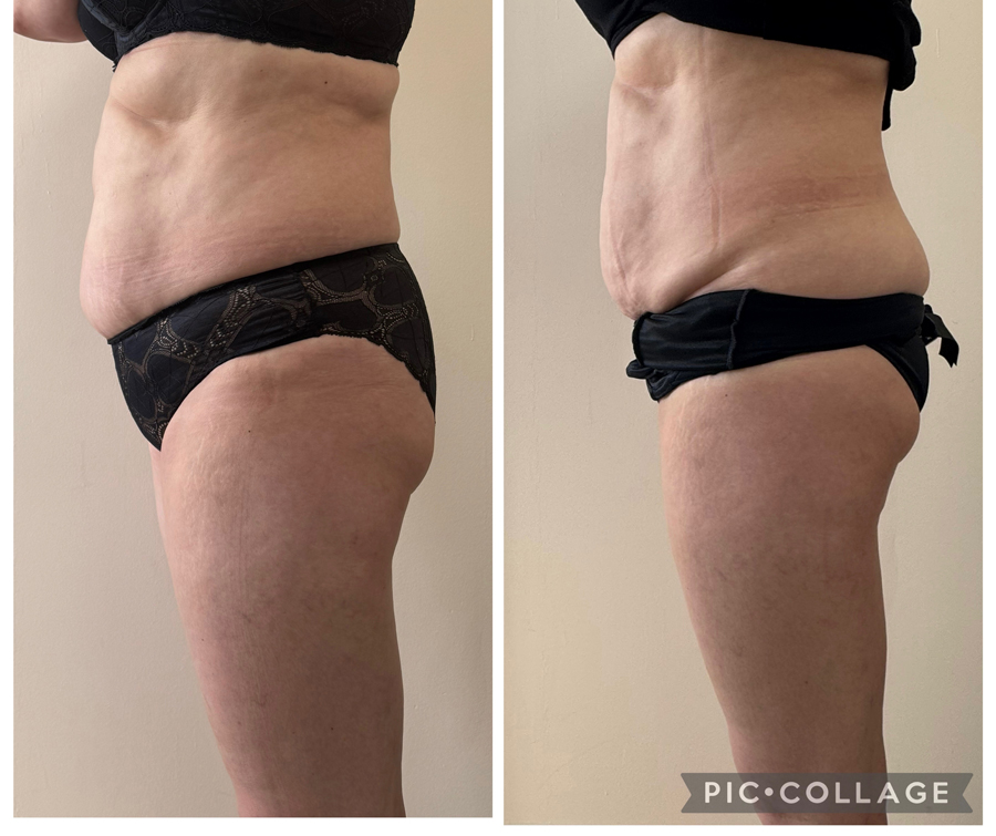 Avant après traitement minceur par Derma Studio