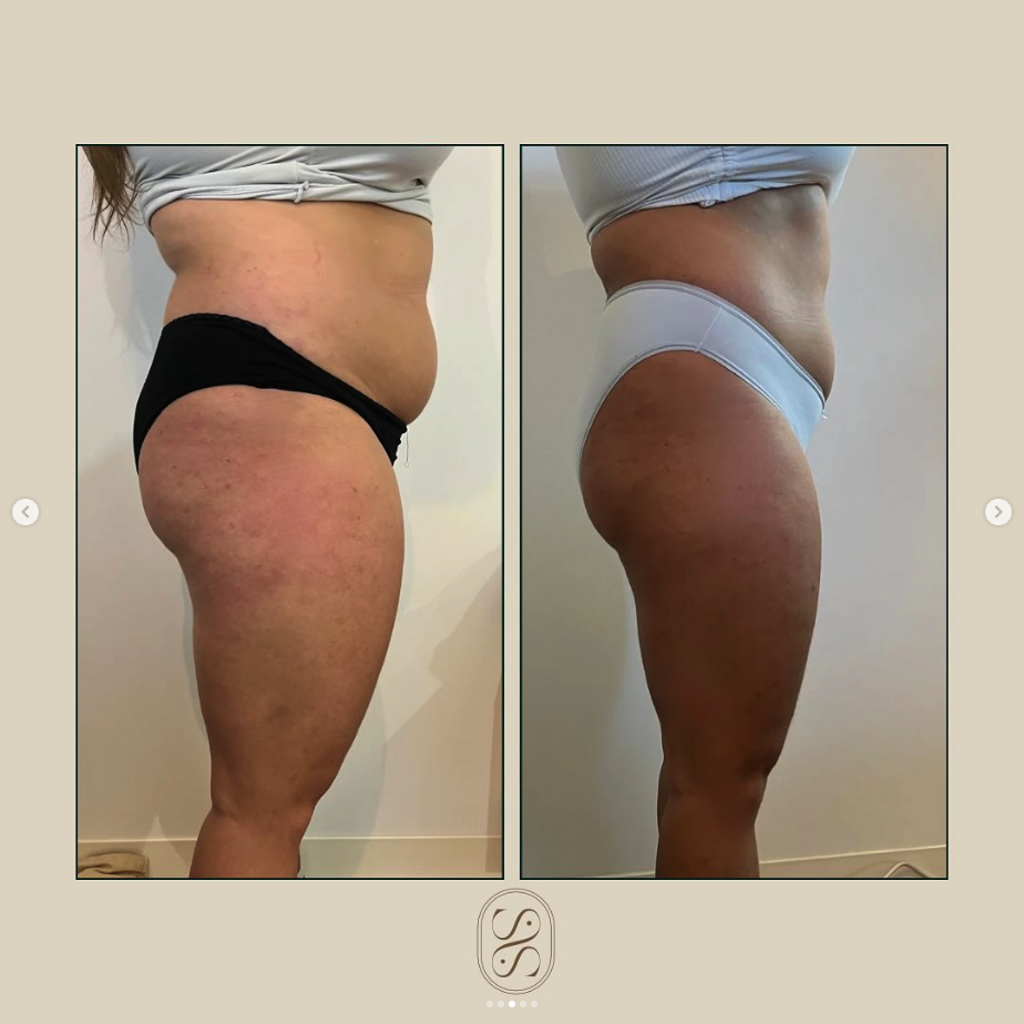 Cure minceur par cryolipolyse : avant / après