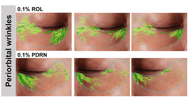 comparaison effets rétinol et PDRN sur les ridules du contour des yeux