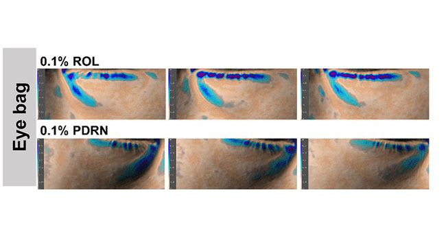 comparaison dees effets du rétinol et des PDRN sur les poches sous les yeux