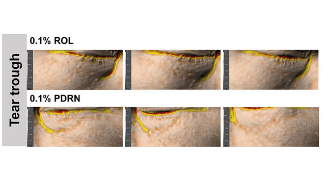 comparaison dees effets du rétinol et des PDRN sur le couloir de larmes