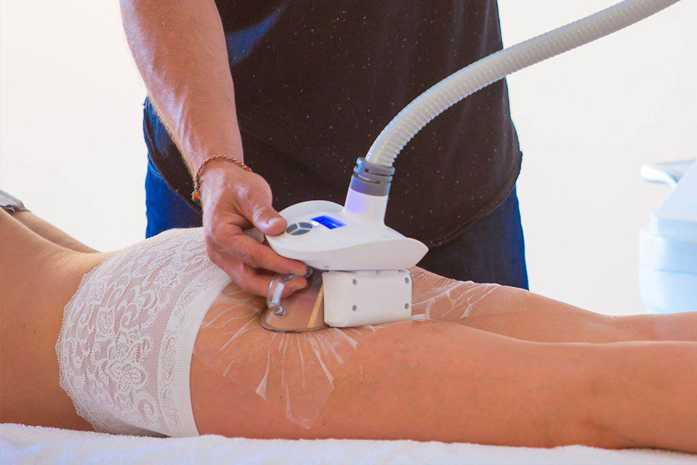 Traitement du pli sous-fessier par cryolipolyse