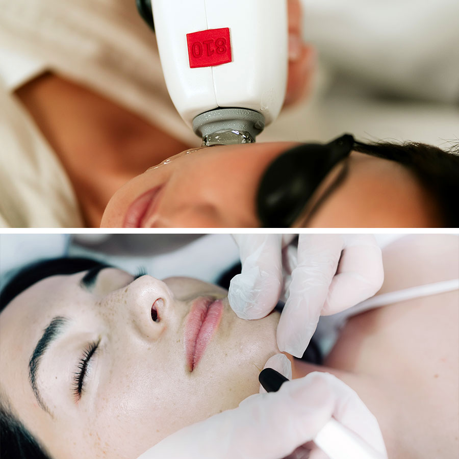 comparaison épilation laser et épilation thermolyse visage