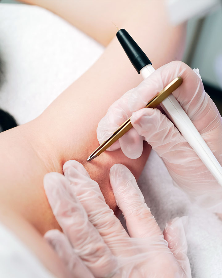 épilation par électrolyse des aisselles