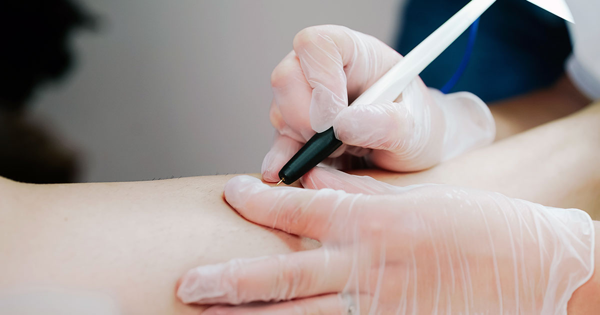 épilation électrique en institut