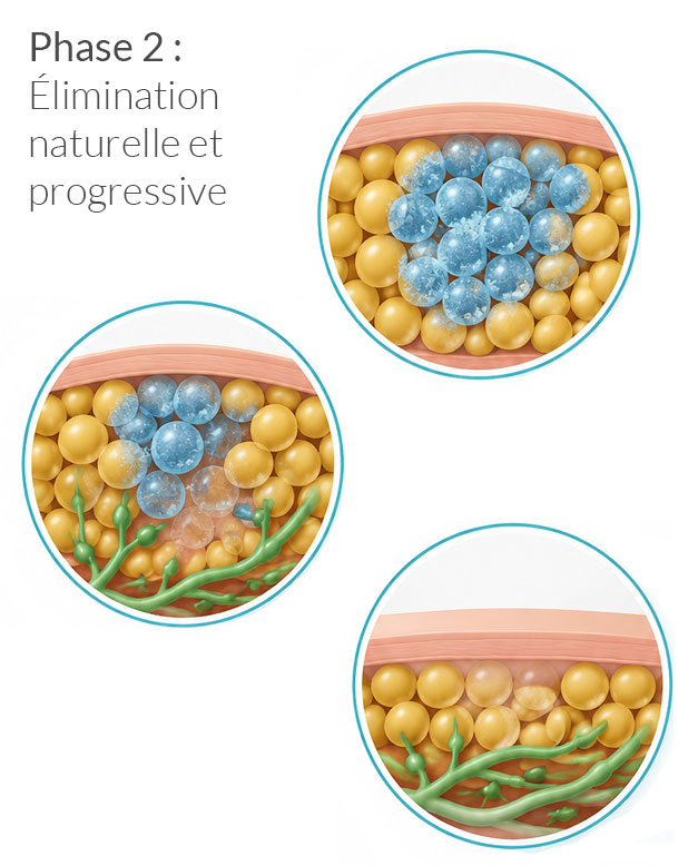 illustration des effets de la cryolipolyse et du processus de réduction de la masse grasse