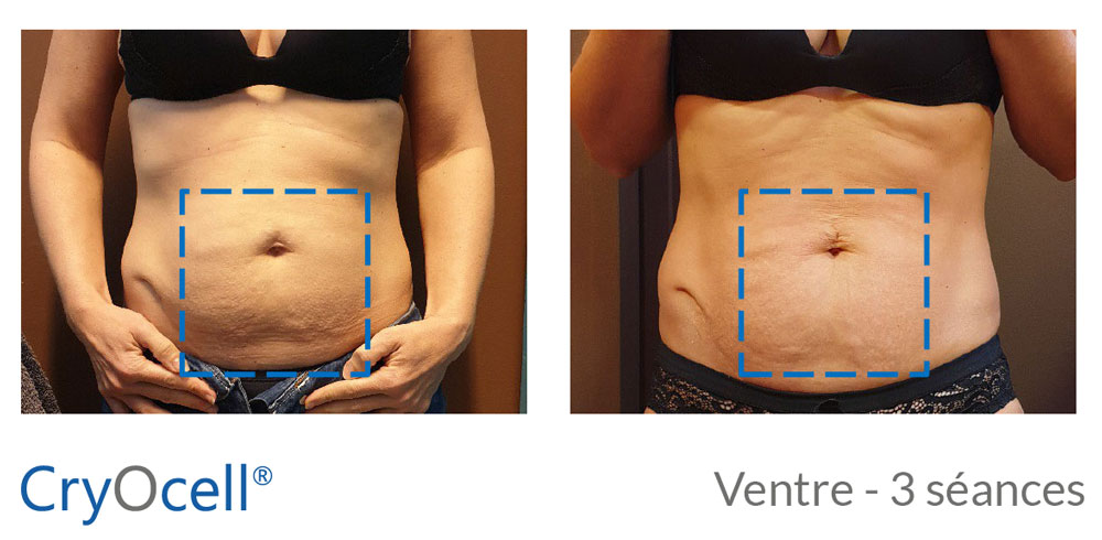 avant après cryolipolyse ventre volume et aspect cutané
