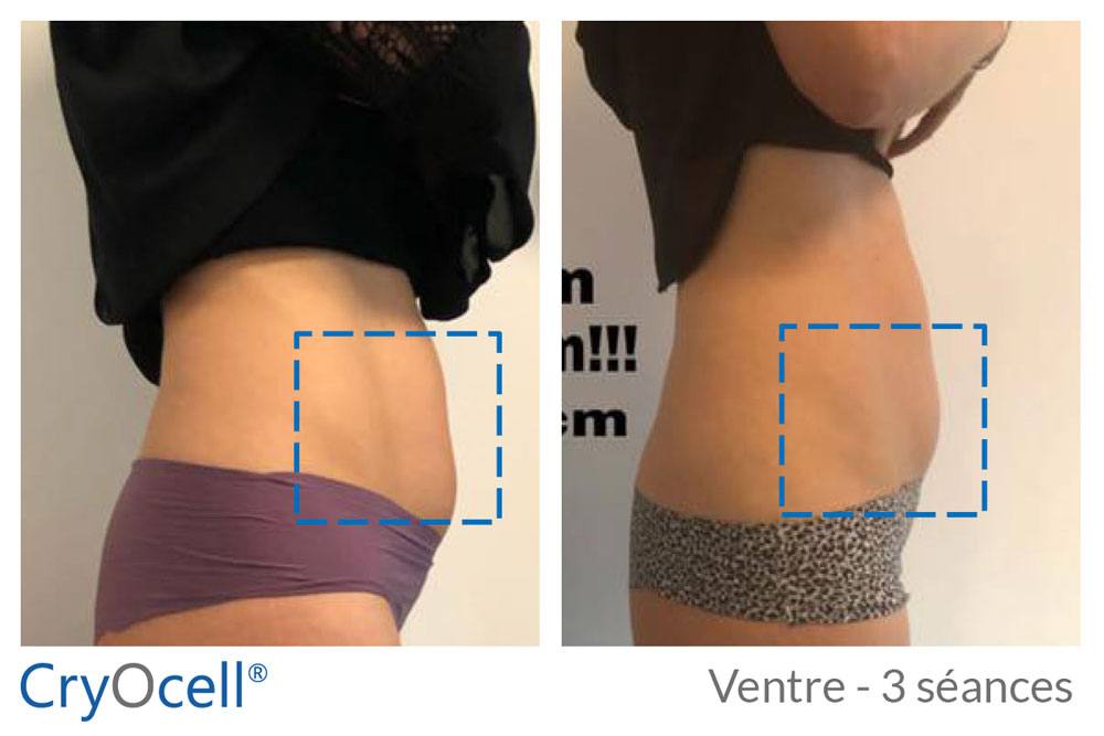 avant après 3 séances cryolipolyse ventre