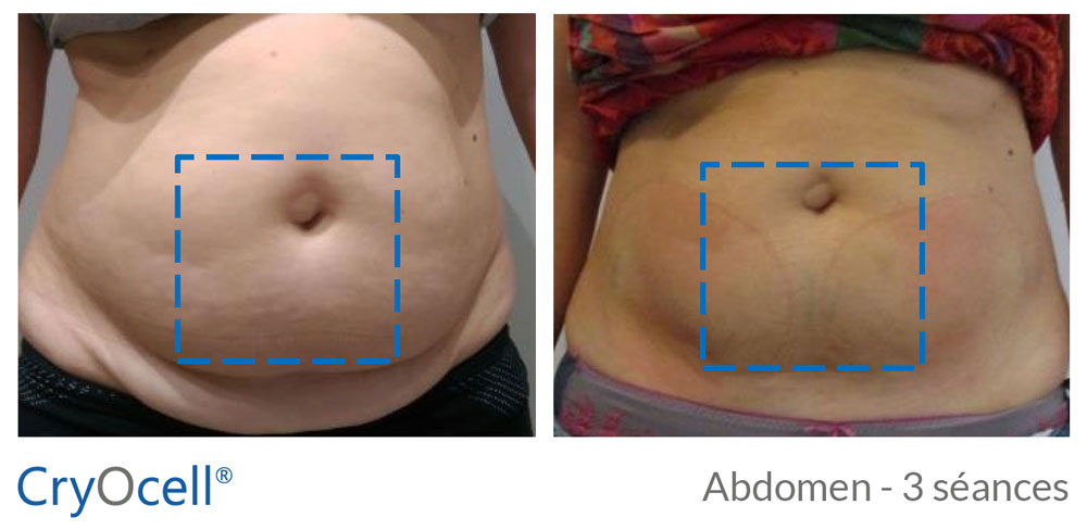 avant après cryolipolyse abdomen
