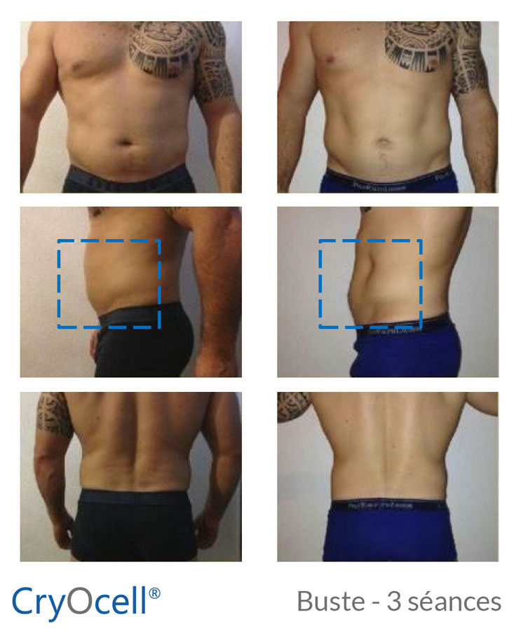 avant après cryolipolyse buste homme