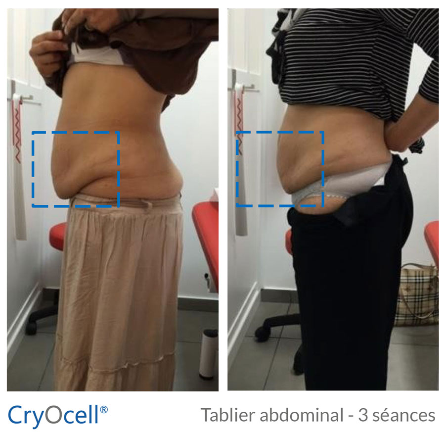 avant après cryolipolyse tablier abdominal