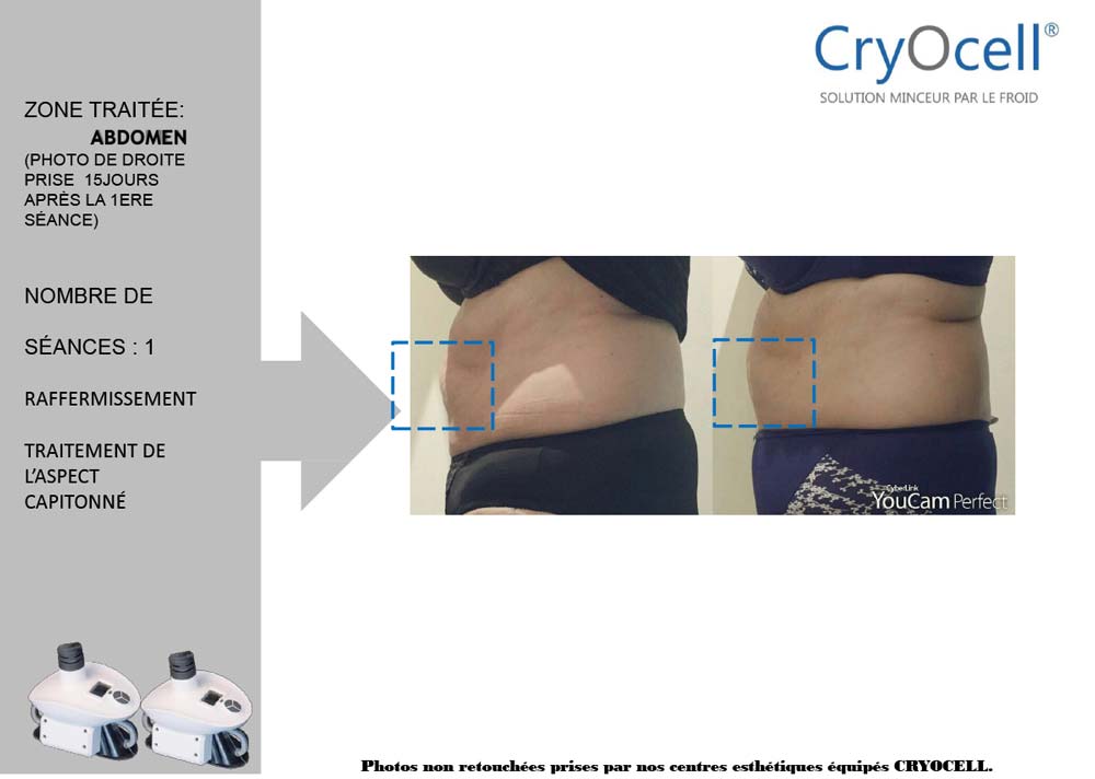 cryolipolyse avant après 1 séance