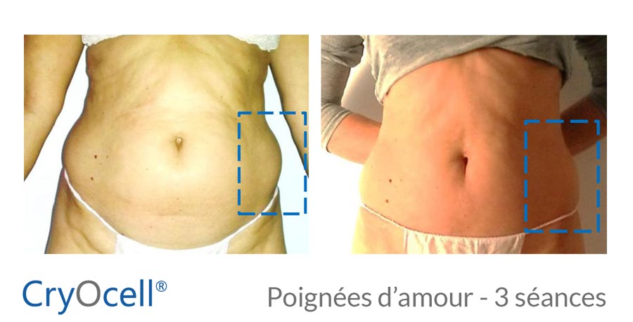 avant après réduction poignées d amour par cryolipolyse