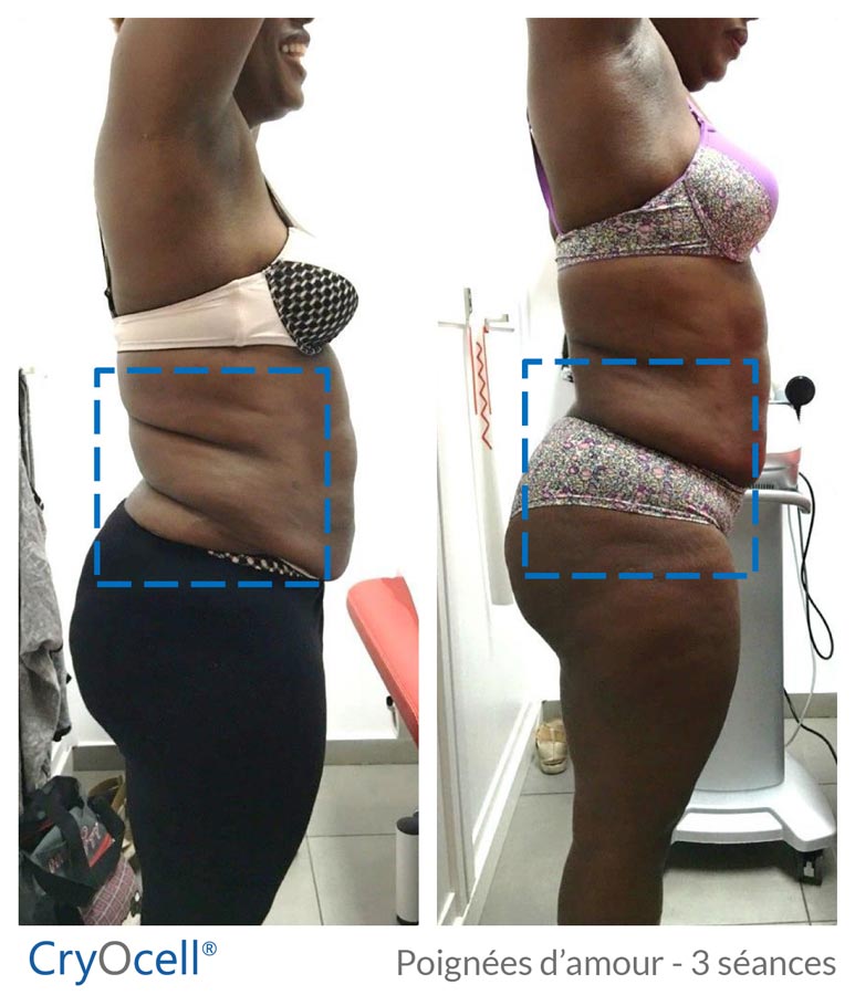 avant après 3 séances cryolipolyse sur les poignées d'amour