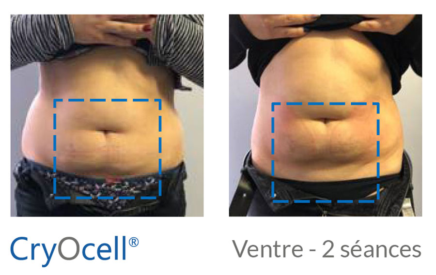 avant après diminution du bourrelet abdominal par cryolipolyse