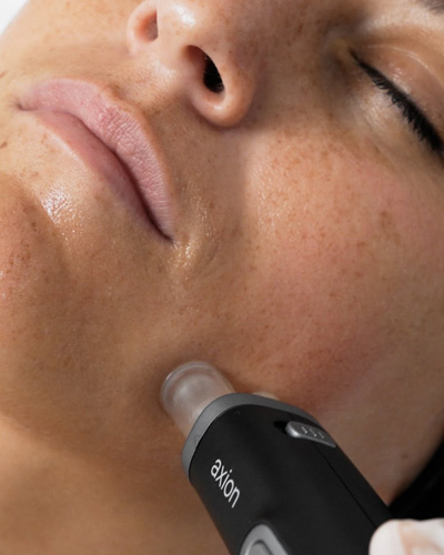 procédure microstimulation axion