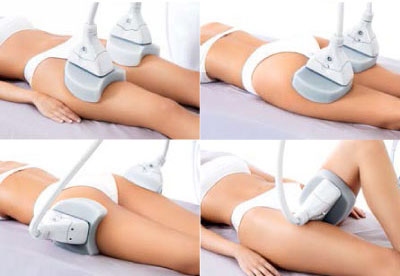 démonstration des 4 façons de positionner les applicateurs de cryolipolyse cuisses