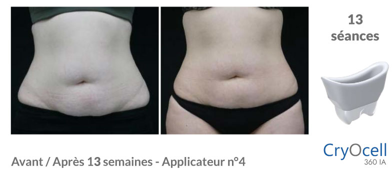 avant après cryolipolyse ventre en 13 semaines